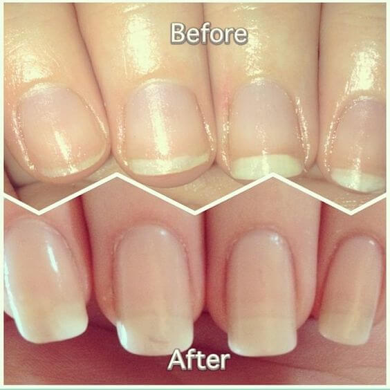 before and after nail growth