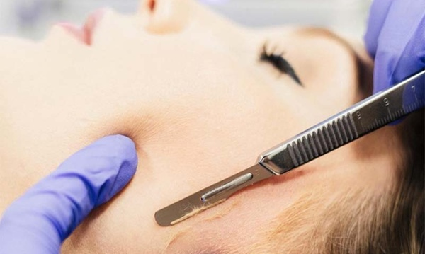 dermaplaning